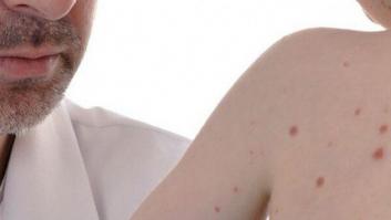 La OMS alerta del "dramático auge" del sarampión en Europa