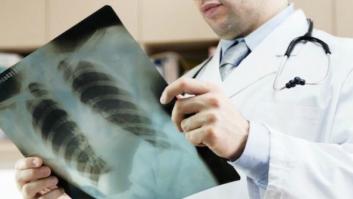 Investigadores españoles descubren un tratamiento que reduce el cáncer de pulmón en un 80% de pacientes