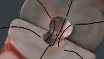 Un estudio desmonta los mitos de la vasectomía: es más reversible y fiable de lo que se piensa