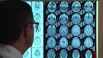 Descubren que un anticoagulante oral retrasa la aparición del alzhéimer