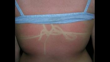 El mensaje viral y doloroso de un tuitero sobre la importancia de la crema solar