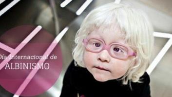 Día Internacional del Albinismo: curiosidades sobre esta alteración genética