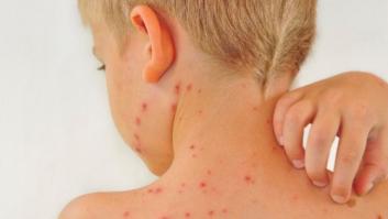 Varicela: La venta de la vacuna efectiva contra la enfermedad está vetada en casi toda España