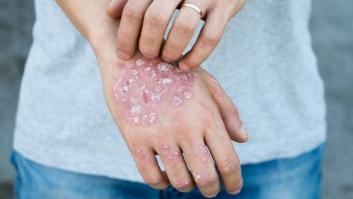 Seis cosas que la gente con psoriasis quiere que sepas