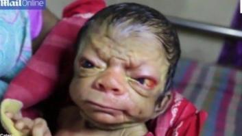 Nace en Bangladesh un bebé con la enfermedad de 'Benjamin Button'