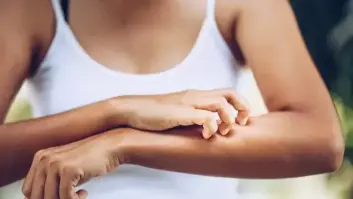 Qué debes hacer cuando te pica un bicho para que el habón no te moleste