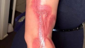 Así queda un brazo si te duermes con un iPhone 7 enchufado encima