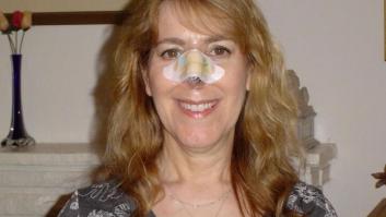 Tuve que quitarme toda la nariz para sobrevivir: así ha cambiado mi vida