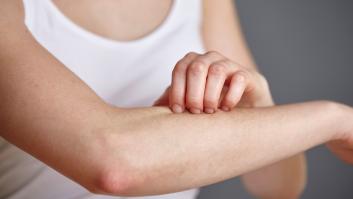 Por qué están aumentando los casos de sarna y cómo prevenirlos