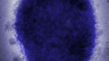 Viruela del mono: diez razones para ser optimistas