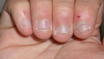 Un británico de 28 años, al borde de la muerte por morderse las uñas