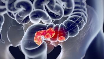 Investigadores del CNIO sugieren la relación entre el consumo de proteínas y el desarrollo de cáncer colorrectal