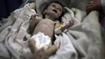 La muerte ronda a los niños malnutridos de los asediados suburbios de Damasco