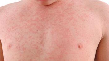 Las alarmantes cifras del sarampión en Italia harán que reflexiones sobre la vacunación