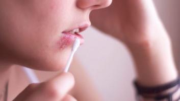 Los herpes pueden causar enfermedades mentales