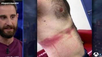 Dani Rovira muestra en 'El Hormiguero' las heridas que sufrió en el rodaje de 'Superlópez'
