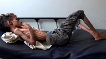 Infierno en Yemen: más de 80.000 niños han muerto de hambre en cuatro años