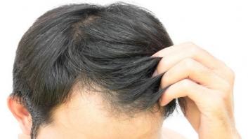 Dejad ya de reíros de los calvos