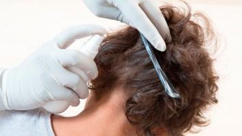 La aplastante crítica de esta experta a las "barbaridades" que recomiendan las autoridades contra los piojos