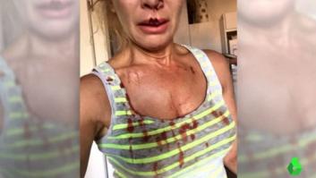 Dos perros sueltos y sin bozal atacan brutalmente a una mujer y le desfiguran la cara