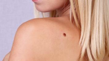 Sufrir cinco quemaduras antes de los 20 años aumenta el riesgo de melanoma un 80%