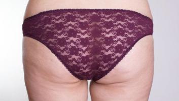 Cuáles son las dudas sobre celulitis que más se buscan en Google