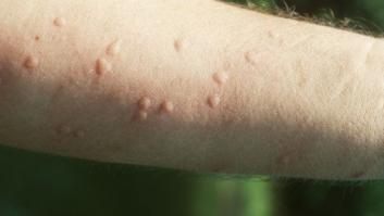 Qué es la urticaria por calor y cómo deshacerse de ella