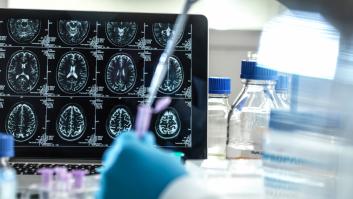 Identifican 75 regiones del genoma relacionadas con el alzhéimer que mejorarán su tratamiento y diagnóstico