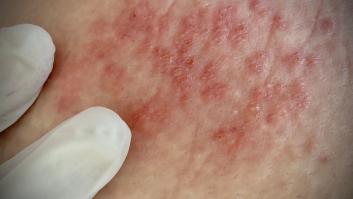 La COVID dispara en España el doloroso virus de la 'culebrilla'