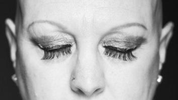 Impactantes fotos de personas con alopecia demuestran que la calvicie es hermosa