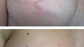 Todo lo que tienes que saber de la micropigmentación de la areola y el pezón