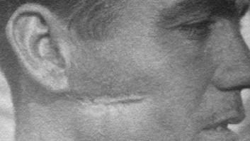 La peor cara de los heridos de la Guerra Civil