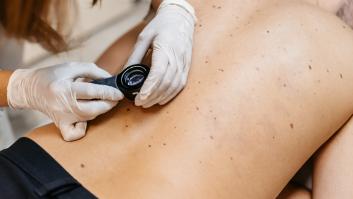 Por qué cada vez hay más melanomas y cuándo sospechar y acudir al dermatólogo