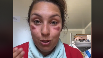 Muestra el increíble efecto en la piel que le ha causado el sol en Nueva Zelanda