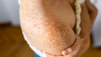 Qué son las líneas de Blaschko, las líneas invisibles que todos tenemos en la piel