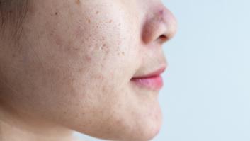 Cuatro alimentos deliciosos que previenen la aparición de manchas en la piel