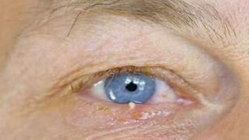 Este es el motivo por el que te salen los orzuelos y cómo tratarlos