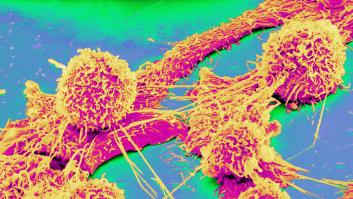 La medicina está muy cerca del motivo de la explosión del cáncer de colon en jóvenes