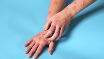 El Reino Unido confirma dos nuevos casos de una nueva variante más contagiosa de mpox