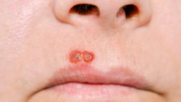 Encuentran un vínculo sorprendente entre el virus del herpes común y el riesgo de sufrir Alzheimer