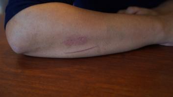 Millones de pacientes se podrán beneficiar de la megatecnología para curar heridas crónicas tres veces más rápido