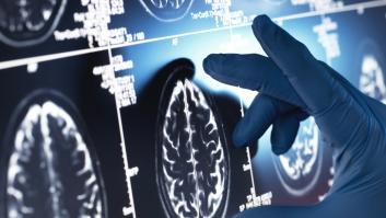 El litio podría explicar la enfermedad de Alzheimer (y también tratarlo)