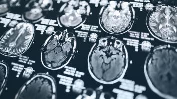 Un neurólogo advierte que la manera de caminar ayuda a detectar las primeras señales de demencia