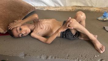 El niño Osama sufre malnutrición: en Gaza no queda comida, afuera es casi imposible salir