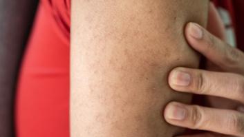 El mejor producto para despedirte de los granitos de los brazos y presumir de piel