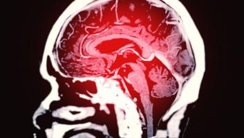 Aviso urgente de un cardiólogo tras revelar la comida que puede desembocar en un ictus