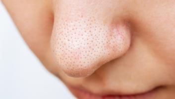 Muchos españoles confunden los puntitos en la nariz con puntos negros: un experto explica qué son realmente