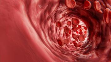 Los investigadores ven algo común en personas que han sufrido síntomas de accidente cerebrovascular y apuntan a un gran problema mundial