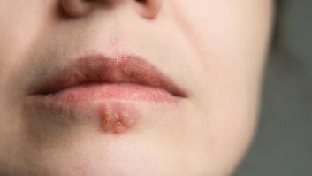 Un estudio asocia el herpes labial a más propensión a desarrollar alzhéimer