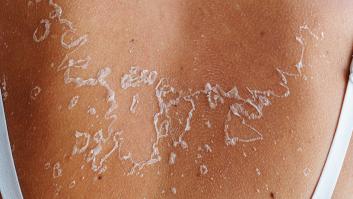 Cinco pautas de una dermatóloga si se te pela la piel por pasarte con el sol